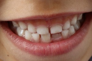 teeth-1743981_960_720.jpg