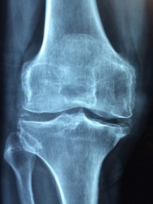 knee-1406964_960_720.jpg